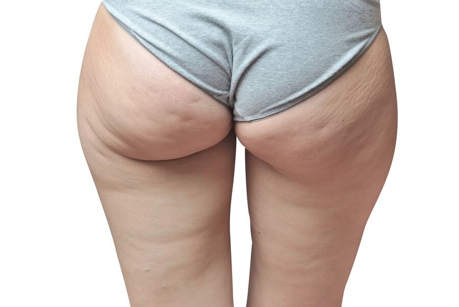 what is a cellulite treatment cream
